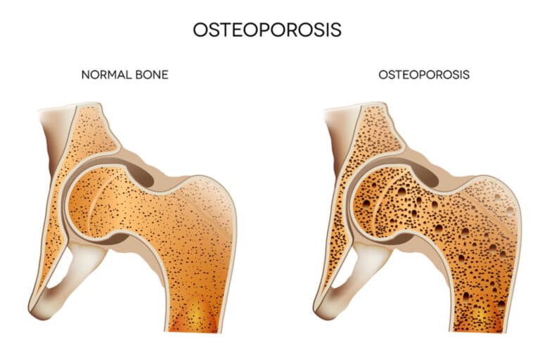 Senior Health: Osteoporosis